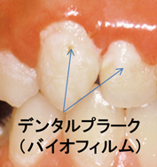 デンタルプラーク