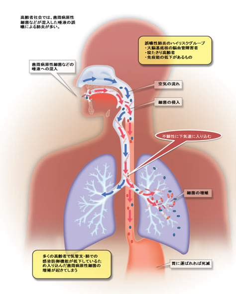 誤嚥性肺炎