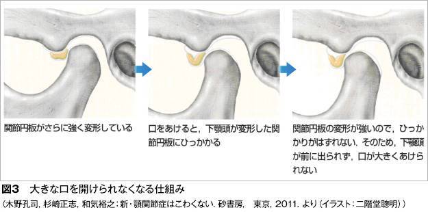 大きなお口が開けられなくなる原因