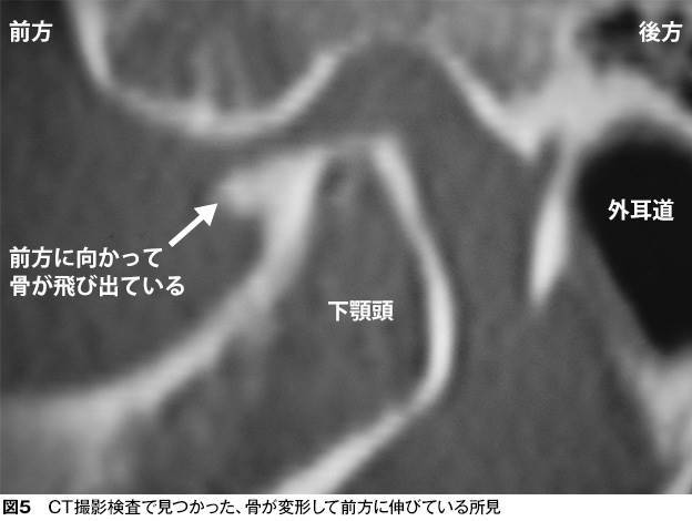 関節頭のCT