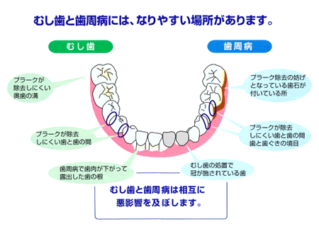 虫歯と歯周病になりやすい場所